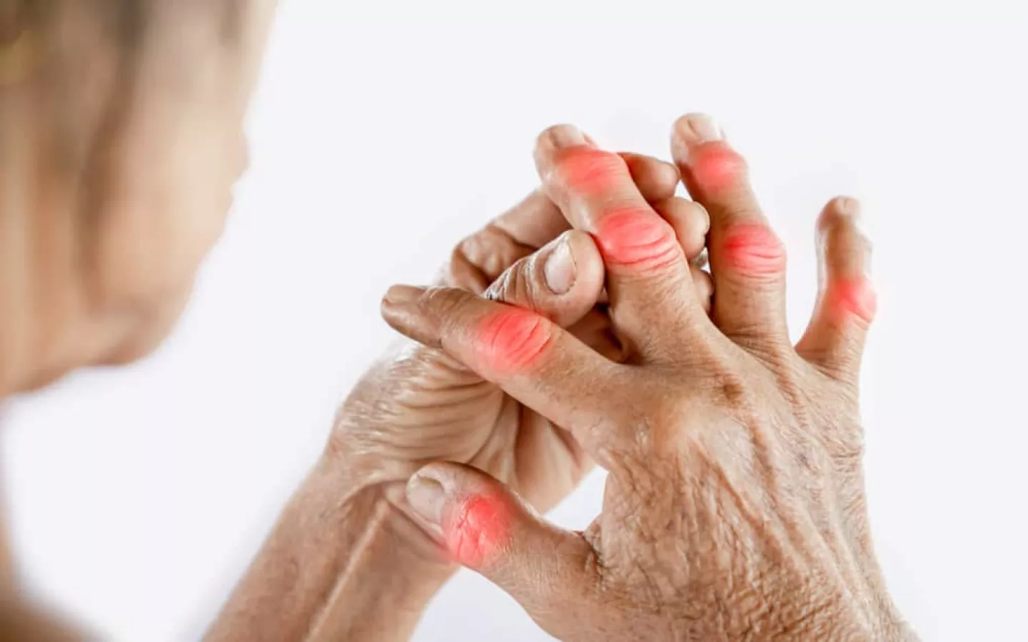 Symptômes de l'arthrose des doigts : causes et remèdes